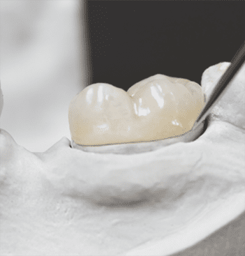 penticton dentists family dental centre dental crown