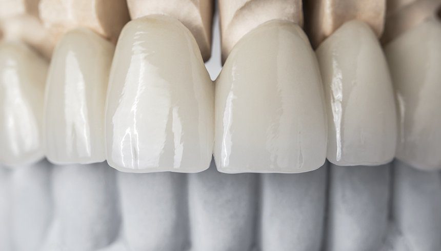 Penticton-Dentist-Enamel-Dental-Centre-Cosmetic-Dentistry-Veneers Enamel Dental Centre Penticton Dentist Cosmetic Dentistry Veneers