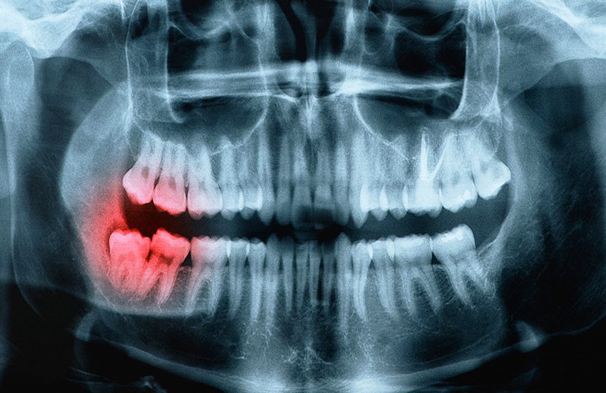 Penticton-Dentist-Enamel-Dental-Centre-Dental-Surgery-Wisdom-Tooth-Teeth-Extractions3