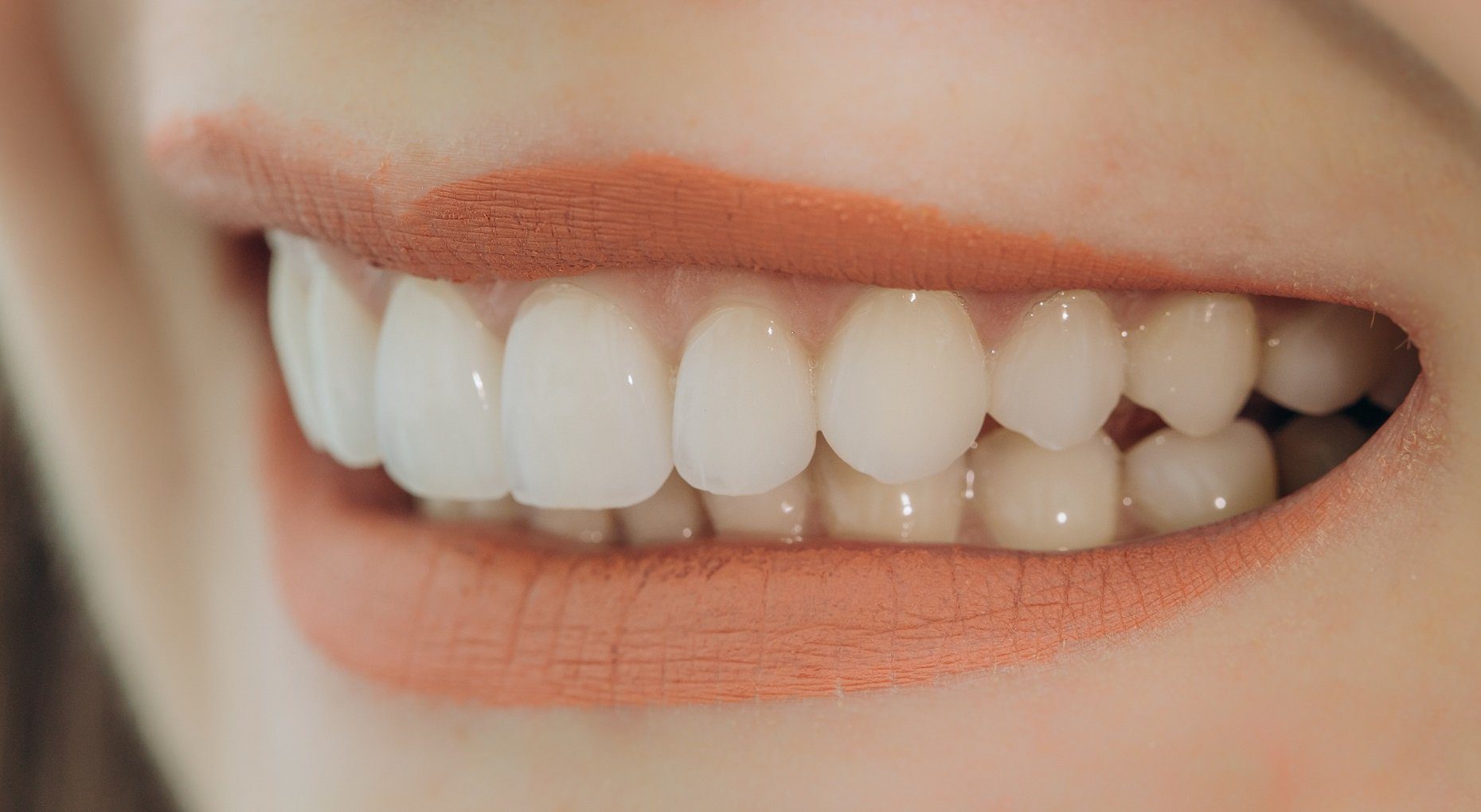 the pros of veneers Hollywood smile with porcelain crowns and veneers