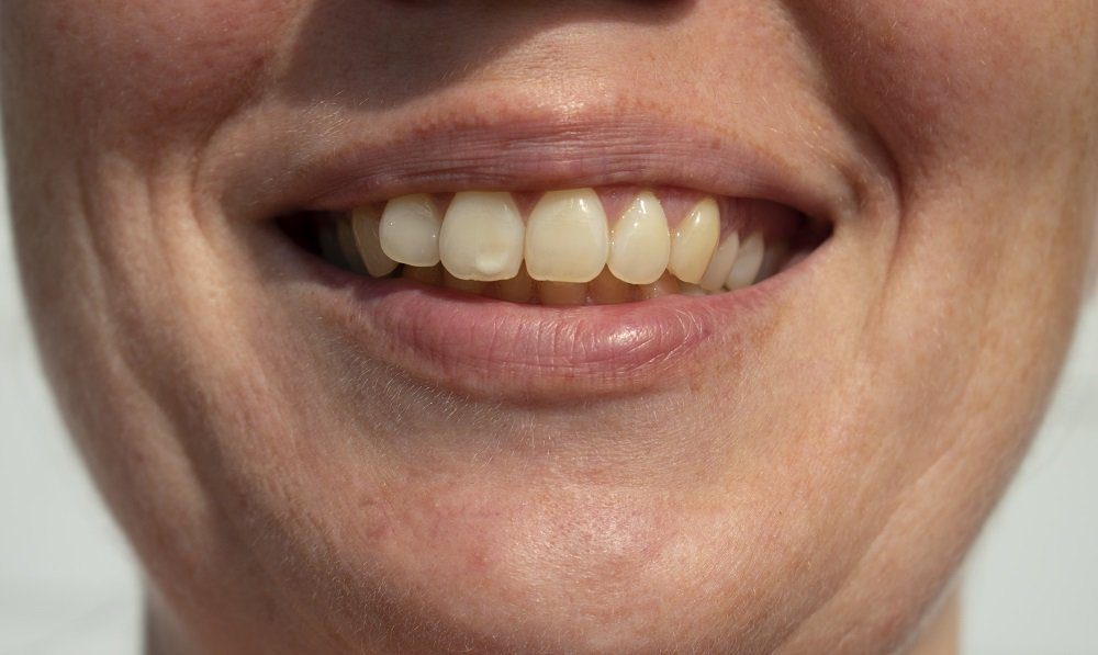 What Causes White Spots on Teeth?