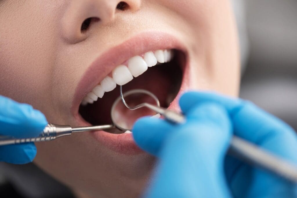 Dentist examining teeth for cavities