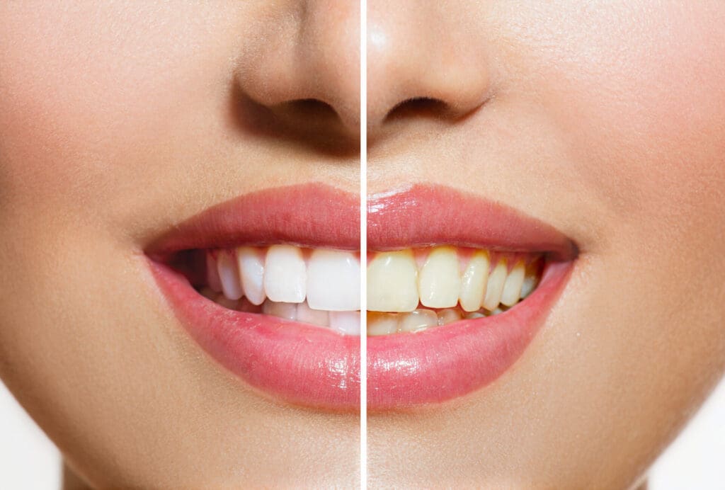 teeth whitening near me