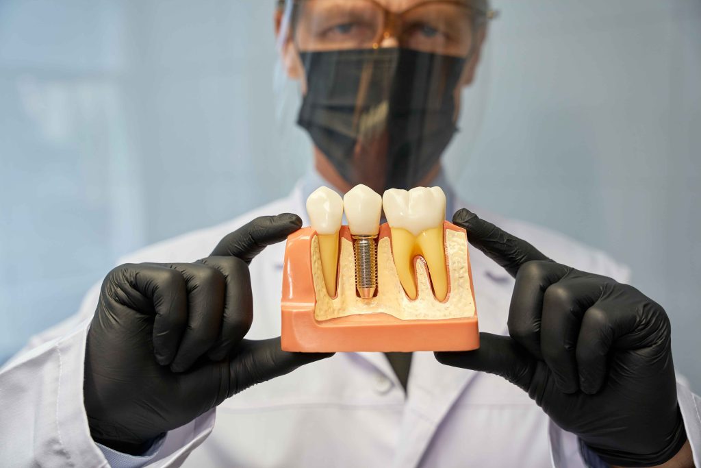 dentist holding dental implant in penticton