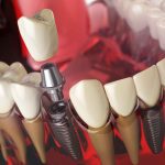 Dental Implants in Penticton: Why Enamel Dental is Your Best Choice