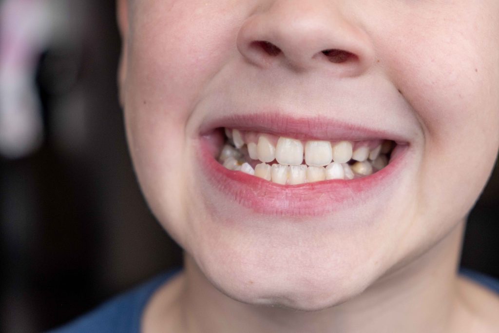 What Causes White Spots on Teeth? Common Reasons & Solutions