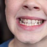 What Causes White Spots on Teeth? Common Reasons & Solutions