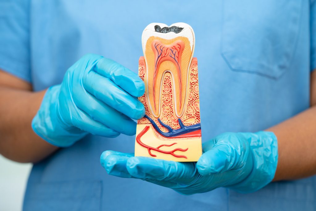 Enamel Decay Stages