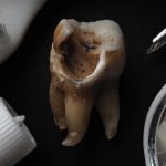The 5 Stages of Tooth Decay and How to Treat Each Stage