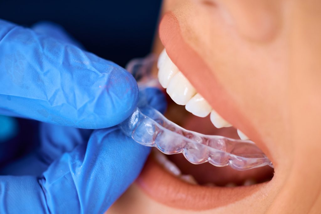 Invisalign Cost in Canada: Price, Process & Braces Comparison