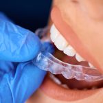 Invisalign Cost in Canada: Price, Process & Braces Comparison