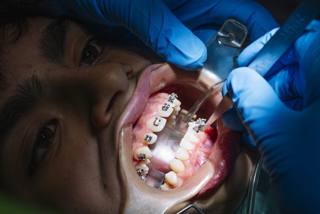 Cost for braces vs Invisalign 