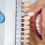 White Spots on Teeth: Causes, Prevention & Treatment