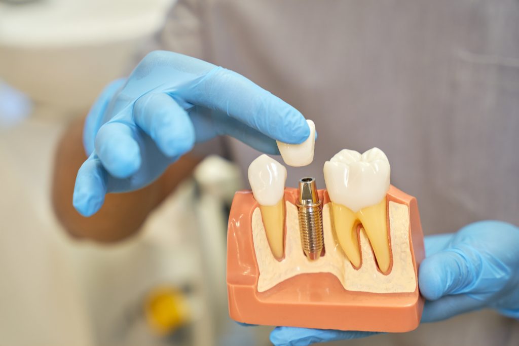 Dental Implants vs Dentures: Crowns, Implant Crowns & Tooth Replacement Options in Penticton