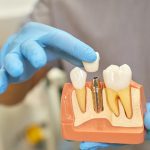 Dental Implants vs Dentures: Crowns, Implant Crowns & Tooth Replacement Options in Penticton